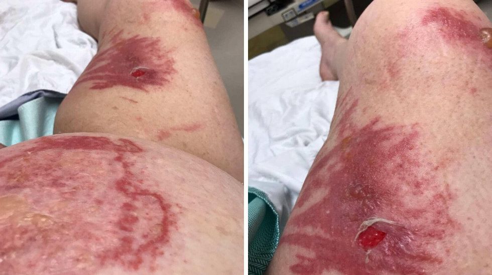 Burns to Lansing's stomach and legs.